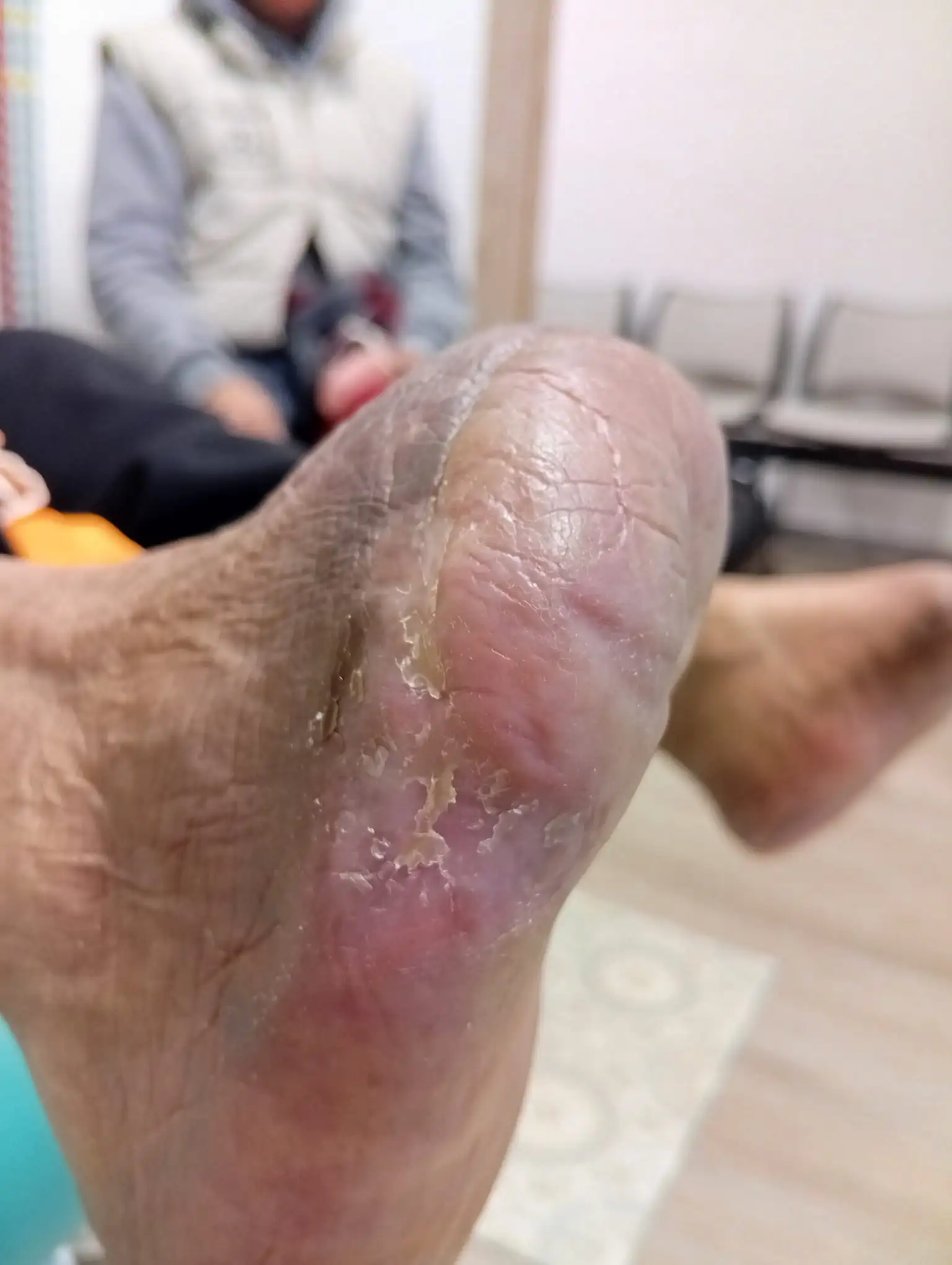 Úlcera Diabética Recuperada